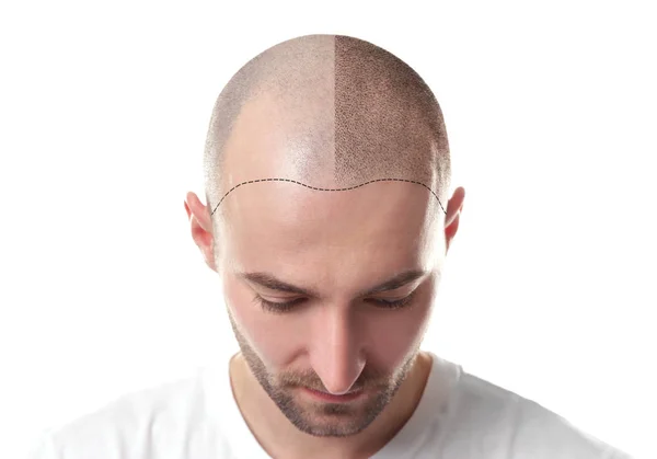 A man looking down with a partially shaven head showing a hairline design, indicating a hair transplant procedure.