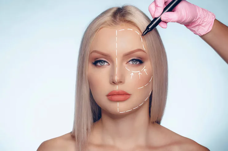 A close-up of a woman's face with marked lines indicating areas for cosmetic facial surgery or enhancement, held by a hand with a pen.